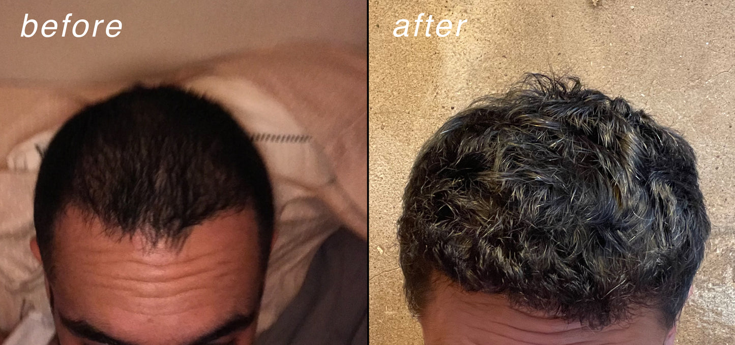 pumpkinseed oil, rosemary oil, minoxidil 5%, castor oil, aloe vera, biotin, strengthening, hair, stop hair loss, rejuvenation, before and after, hair serum, light therapy, prp